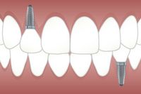 Изберете зъбни импланти цени 7
