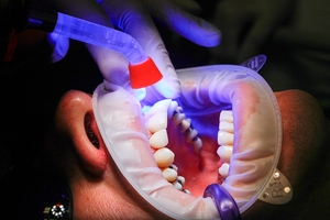 Best Deals on Dental Implants 38