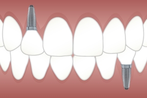 The best on the market Dental Implants 7